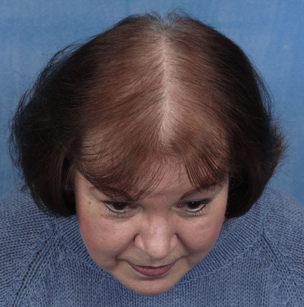 Hairstyles For Balding Women
 what cause hair loss All About hair loss