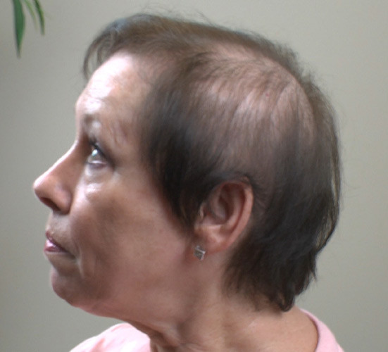 Hairstyles For Balding Women
 Women with thinning hair Hairstyle for women & man