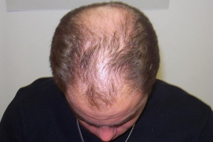 Male Pattern Baldness Hairstyle
 male pattern baldness hairstyles male pattern baldness