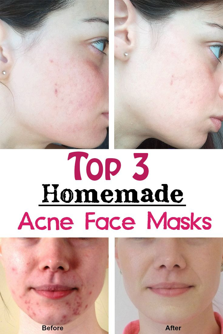 Best ideas about Best DIY Acne Mask
. Save or Pin Top 3 Homemade Acne Face Masks Now.