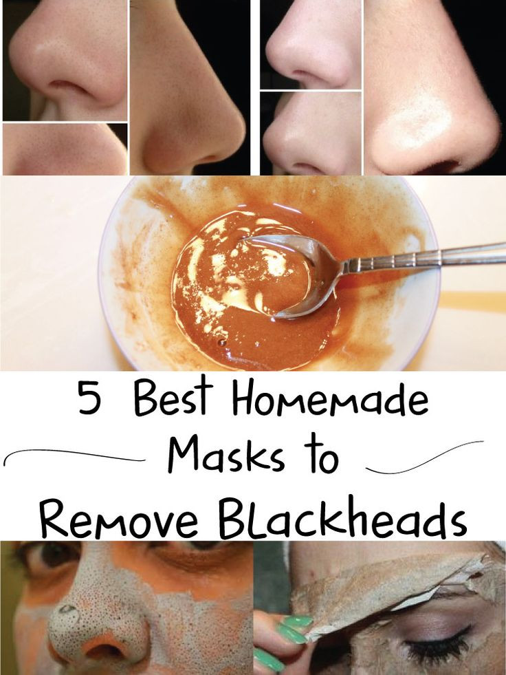 Best ideas about Best Face Mask For Blackhead Removal DIY
. Save or Pin 5 Best Homemade Masks to Remove Blackheads Joys Fit Now.