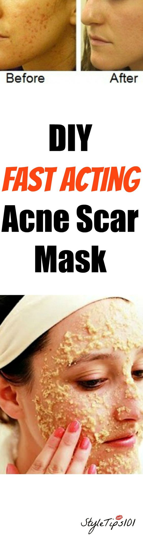 Best ideas about DIY Acne Scar Mask
. Save or Pin DIY Acne Scar Mask Now.