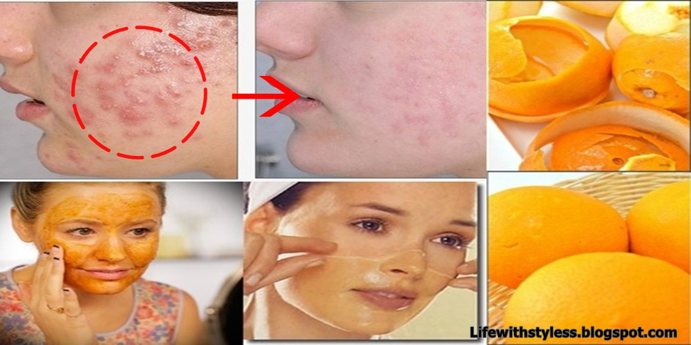 Best ideas about DIY Acne Scar Mask
. Save or Pin Homemade Orange Peel Face Mask For Pimples And Acne Scars Now.