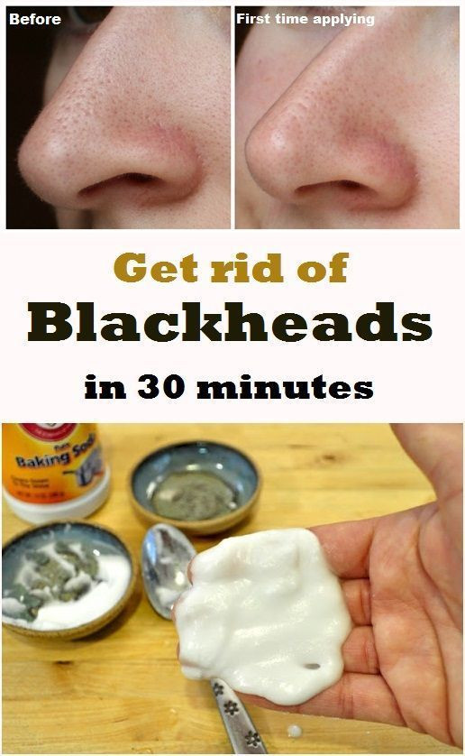 Best ideas about DIY Blackhead Removal
. Save or Pin 7 DIY Blackhead Reme s To Try At Home – Go Healthy Now.