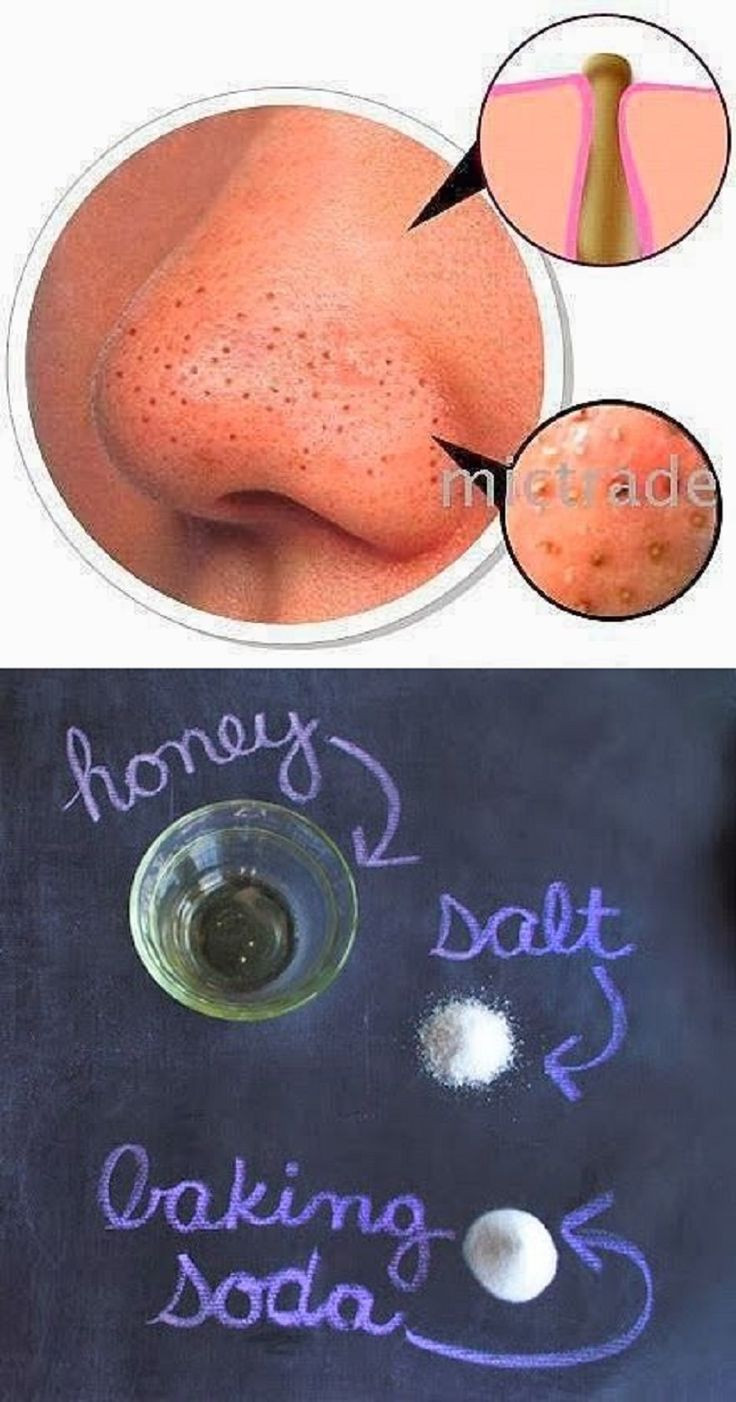 Best ideas about DIY Blackhead Removal
. Save or Pin 8 Beauty DIY Tips and Tricks Hacks HealthPositiveInfo Now.