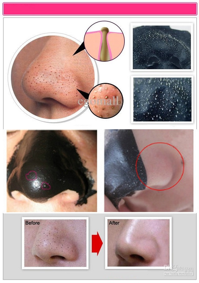 Best ideas about DIY Blackhead Removal
. Save or Pin Blackheads Removing Mask AllDayChic Now.