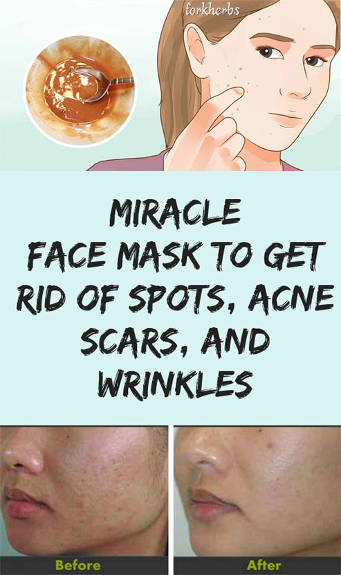 Best ideas about DIY Face Mask To Get Rid Of Acne
. Save or Pin HOMEMADE MIRACLE FACE MASK TO GET RID OF ACNE SCARS Now.