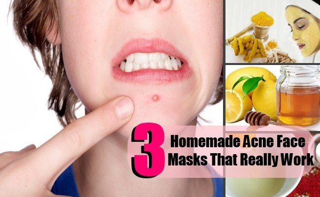 Best ideas about DIY Masks For Acne
. Save or Pin 3 DIY Homemade Acne Face Masks That Really Work Now.