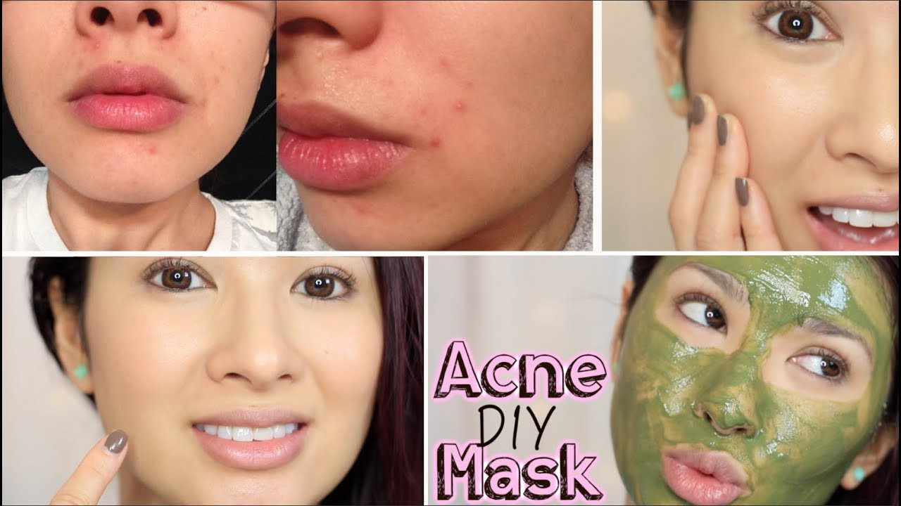 Best ideas about Acne DIY Mask
. Save or Pin DIY Acne Mask Now.