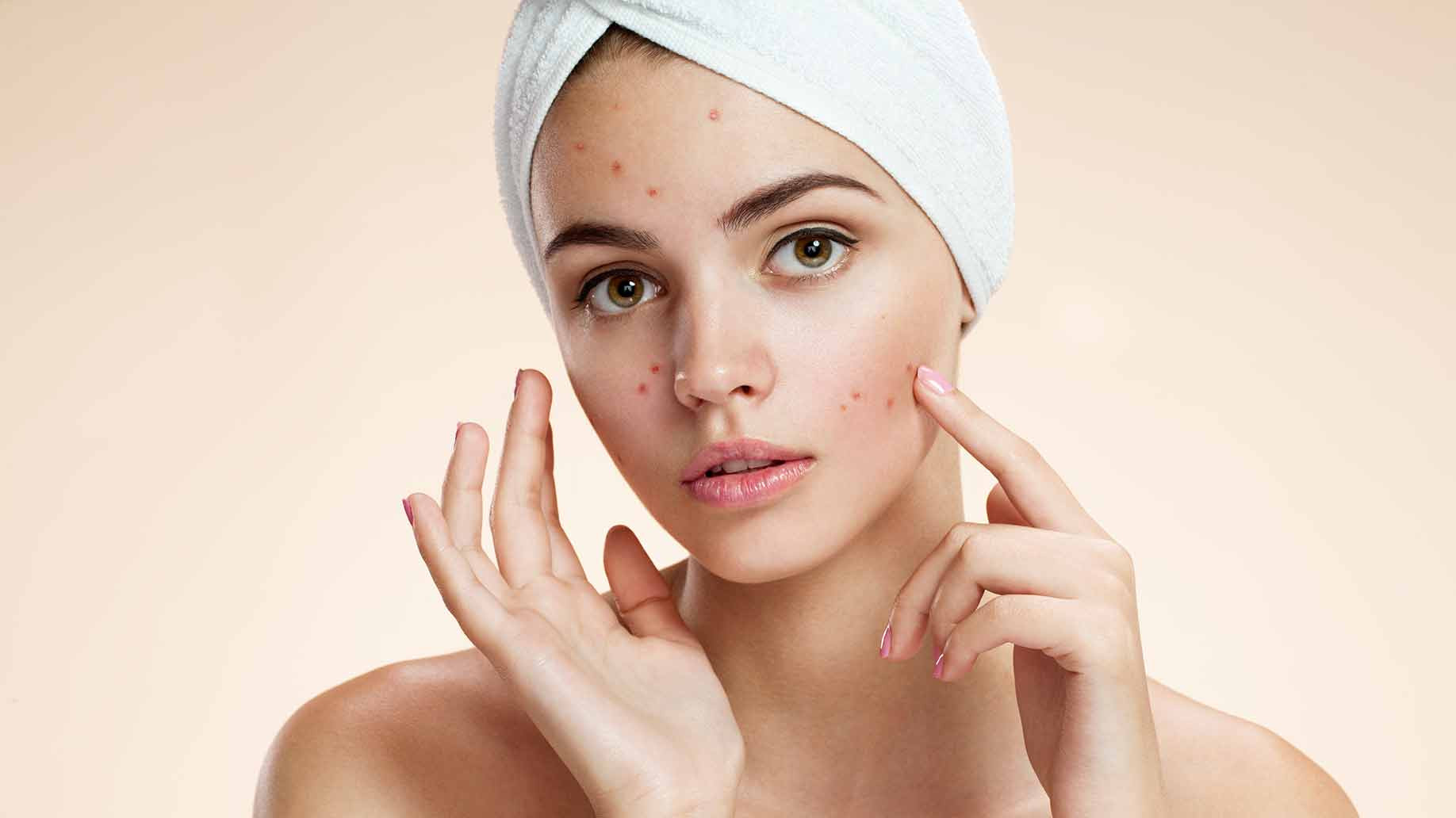 Best ideas about Acne Facial Mask DIY
. Save or Pin 6 Best Homemade DIY Face Masks for Acne Recipes on How Now.