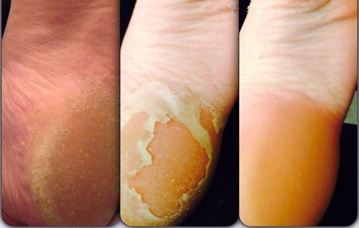 Best ideas about Baby Foot Peel DIY
. Save or Pin What The Heck Is In Baby Foot—And Is It Safe Now.
