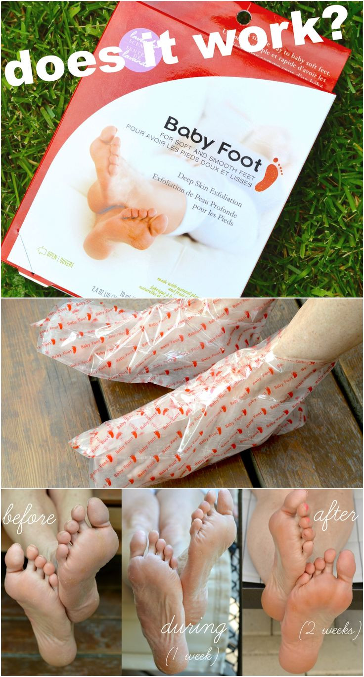Best ideas about Baby Foot Peel DIY
. Save or Pin See the results when using Baby Foot chemical peel for the Now.
