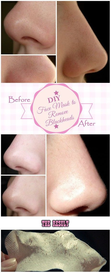 Best ideas about DIY Face Mask To Remove Blackheads
. Save or Pin Blackheads Removal a collection of ideas to try about Now.