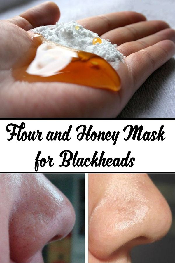 Best ideas about DIY Face Masks For Blackheads
. Save or Pin Best 25 Get Rid Blackheads ideas on Pinterest Now.