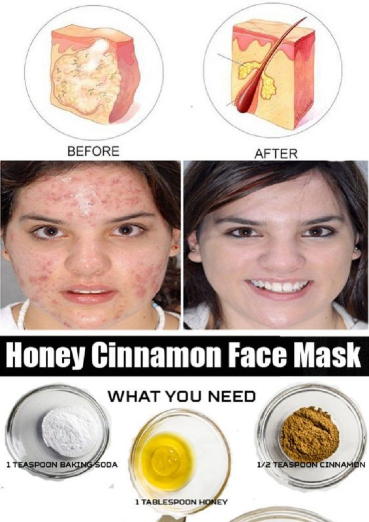 Best ideas about DIY Facial Mask For Acne Scars
. Save or Pin Honey and Cinnamon Face Mask for Cystic Acne 11 Anti Now.