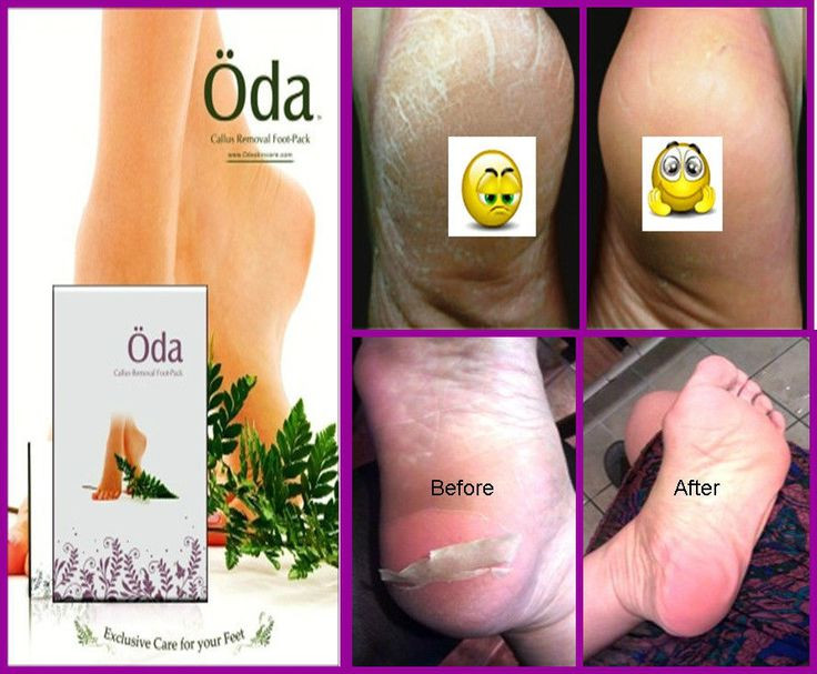 Best ideas about DIY Foot Mask
. Save or Pin Oda Beauty Baby Foot Exfoliate Peel Rough Callus Remover Now.