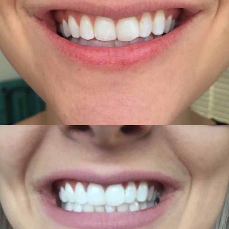 Best ideas about Activated Charcoal Teeth Whitening DIY
. Save or Pin Best 25 Activated charcoal teeth ideas on Pinterest Now.