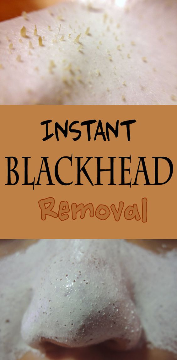 Best ideas about Blackhead Removal DIY
. Save or Pin Pinterest • The world’s catalog of ideas Now.