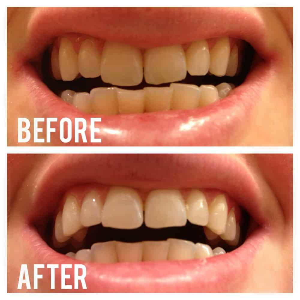 Best ideas about Charcoal Teeth Whitening DIY
. Save or Pin Whitening Your Teeth Naturally With Activated Charcoal Now.