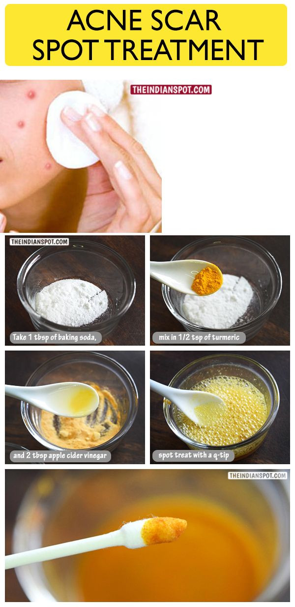 Best ideas about DIY Acne Spot Treatment
. Save or Pin BEAUTY DIY SPOT TREATMENT FOR ACNE SCAR and DARK SPOTS Now.