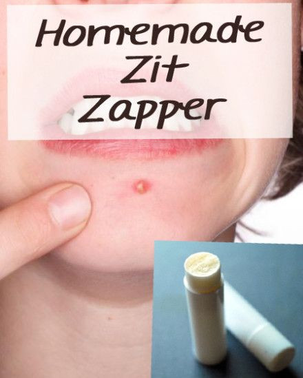 Best ideas about DIY Acne Treatment
. Save or Pin DIY Natural Remedy Acne Spot Treatment – Homemade Zit Now.