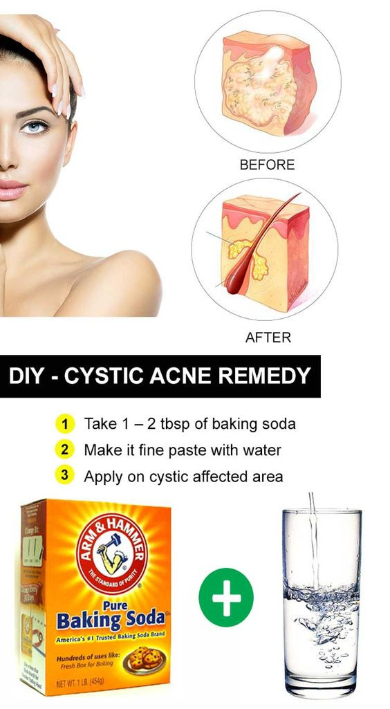 Best ideas about DIY Acne Treatment
. Save or Pin DIY Reme s for Cystic Acne Now.