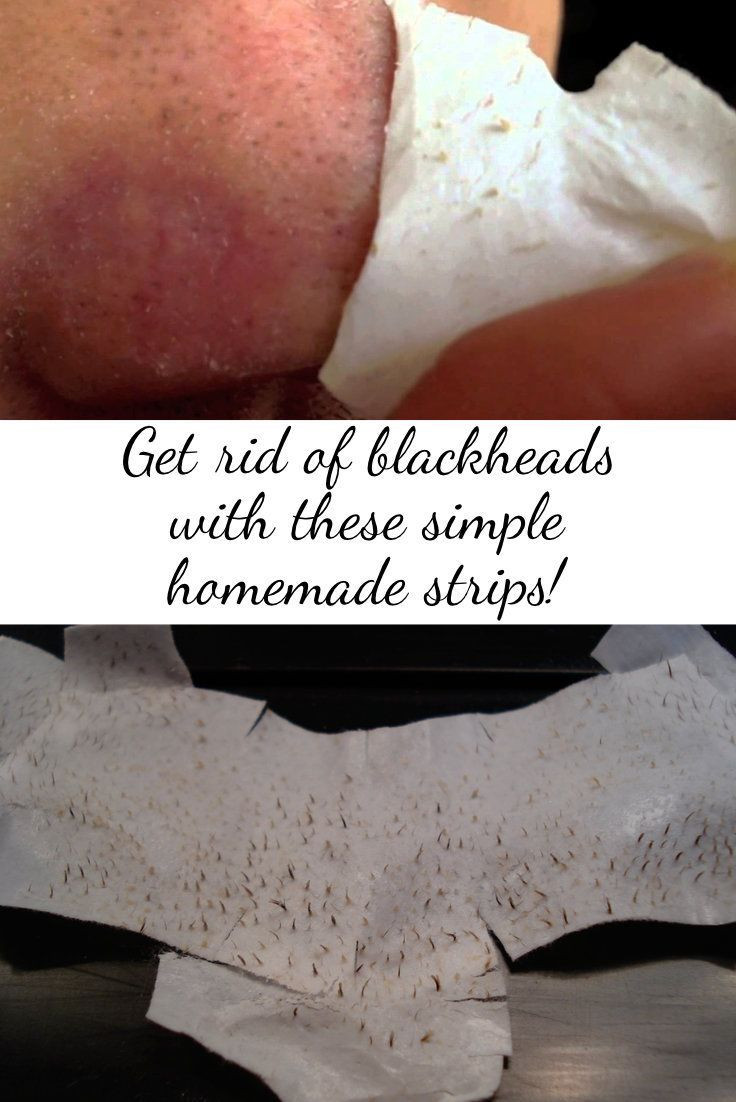 Best ideas about DIY Blackhead Strips
. Save or Pin 17 Best images about Homemade Pore Strips on Pinterest Now.