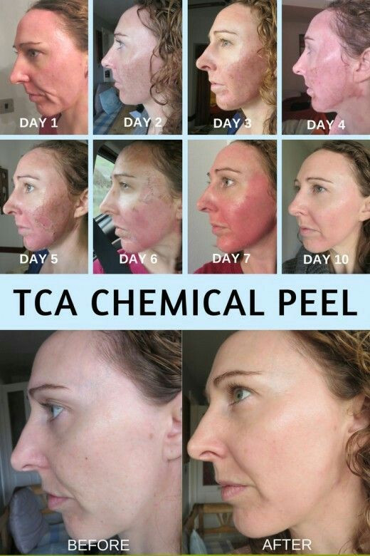 Best ideas about DIY Chemical Peel
. Save or Pin Best 25 Chemical peel ideas on Pinterest Now.
