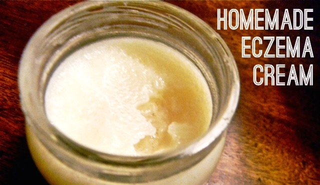 Best ideas about DIY Eczema Cream
. Save or Pin How To Make A Homemade Eczema Cream Now.