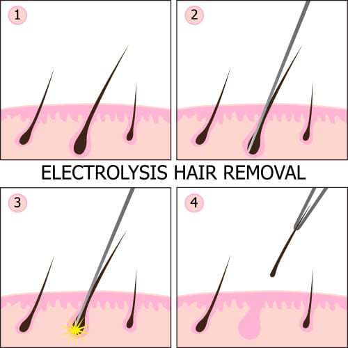 Best ideas about DIY Electrolysis Hair Removal
. Save or Pin Is DIY Electrolysis Safe and Effective Now.