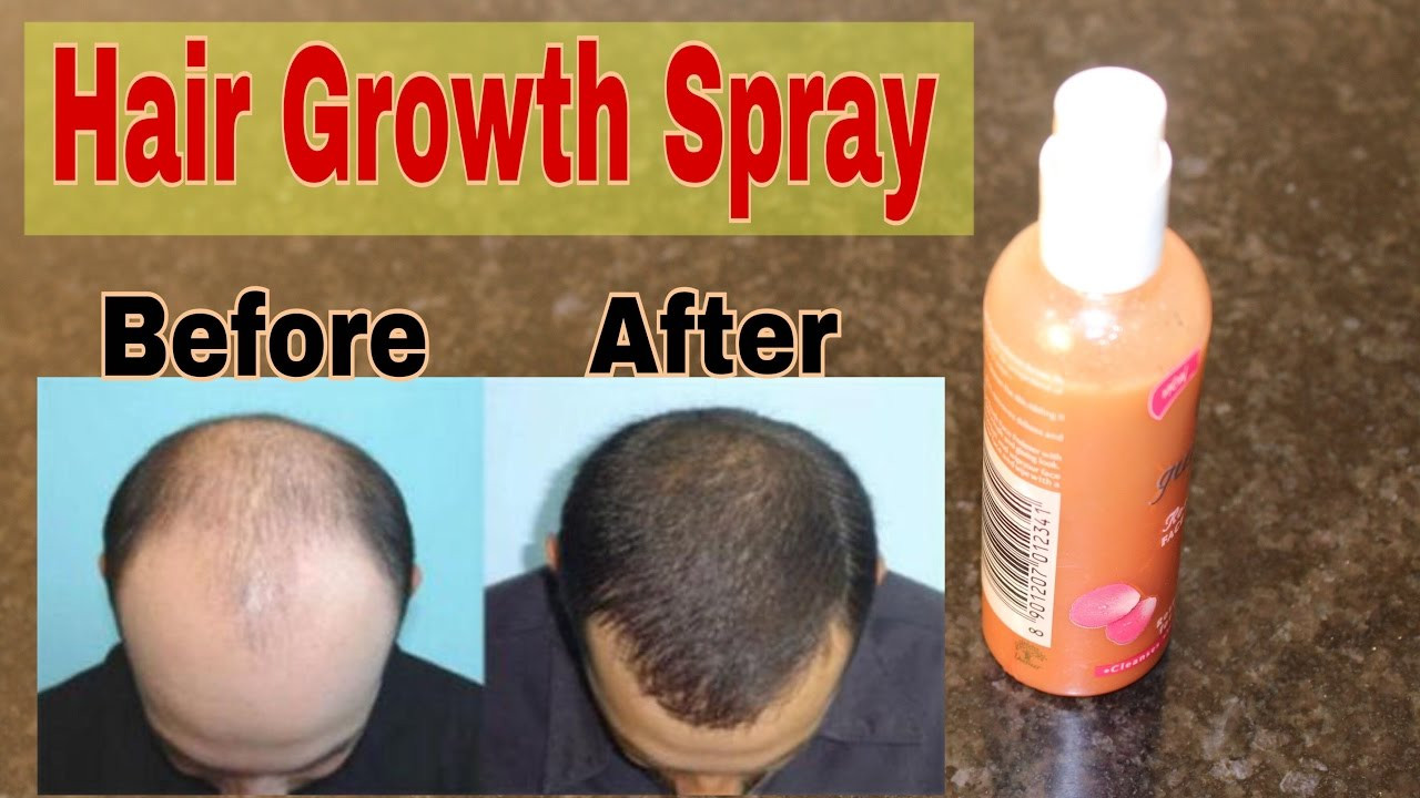 Best ideas about DIY Hair Growth Spray
. Save or Pin HAIR GROWTH SPRAY for BALDNESS HAIR LOSS SCALP INFECTION Now.