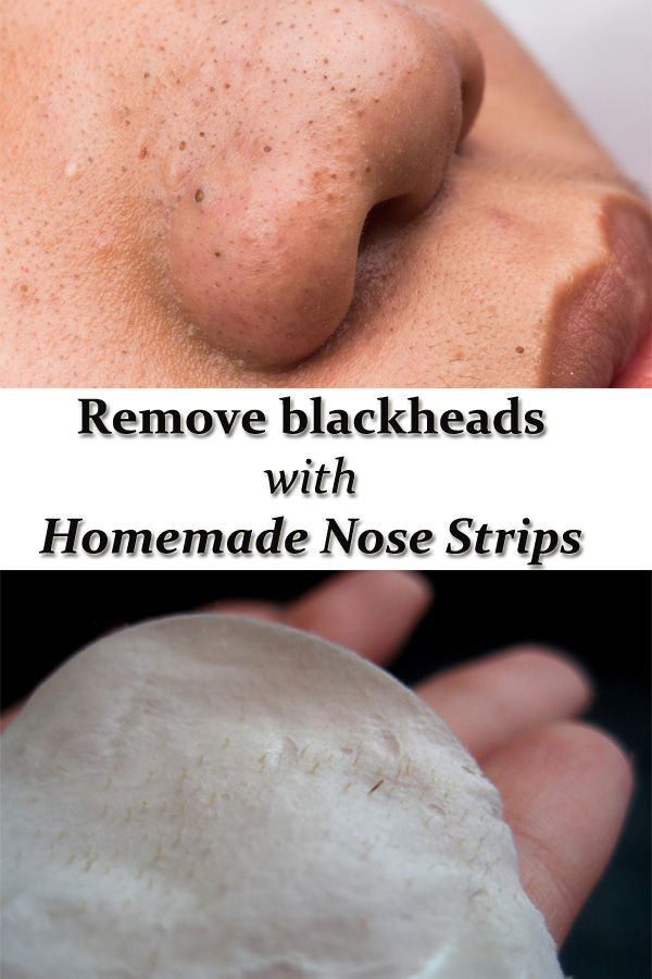 Best ideas about DIY Nose Strip
. Save or Pin REMOVE BLACKHEADS WITH HOMEMADE NOSE STRIPS Now.