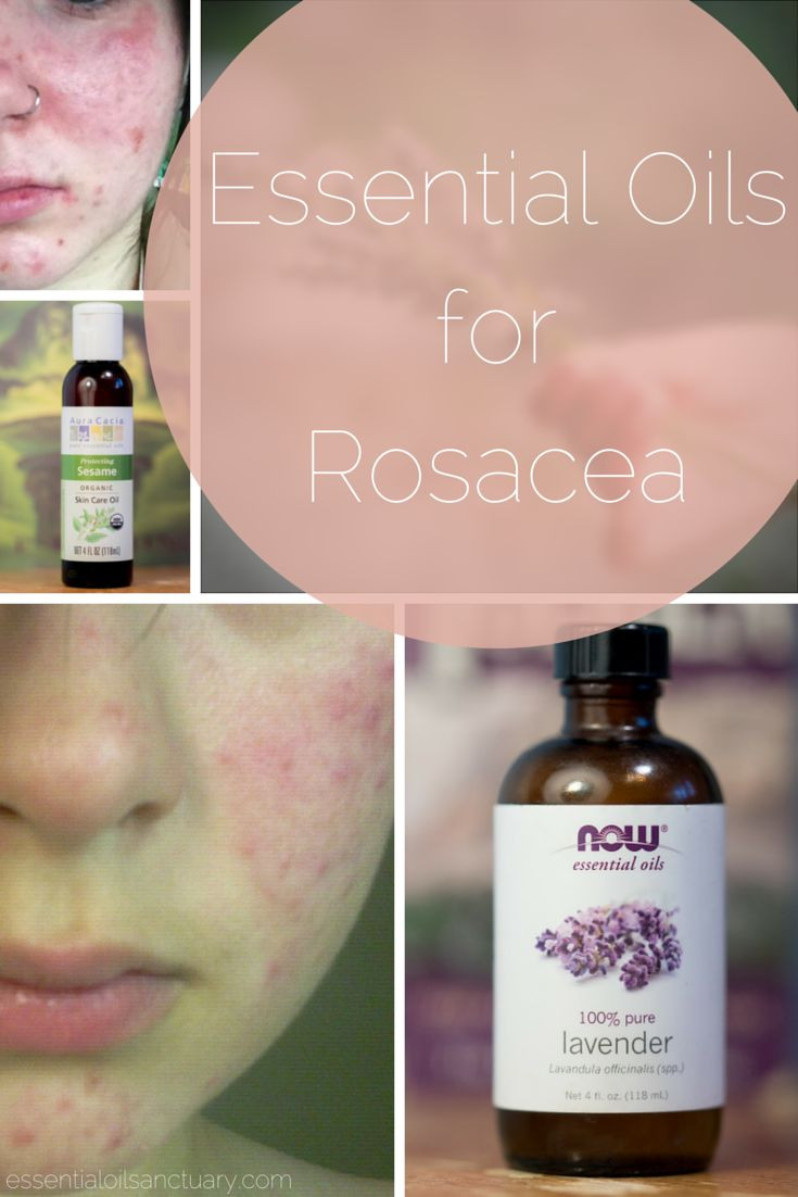 Best ideas about DIY Rosacea Treatment
. Save or Pin 132 best images about DIY Rosacea Natural Reme s on Now.