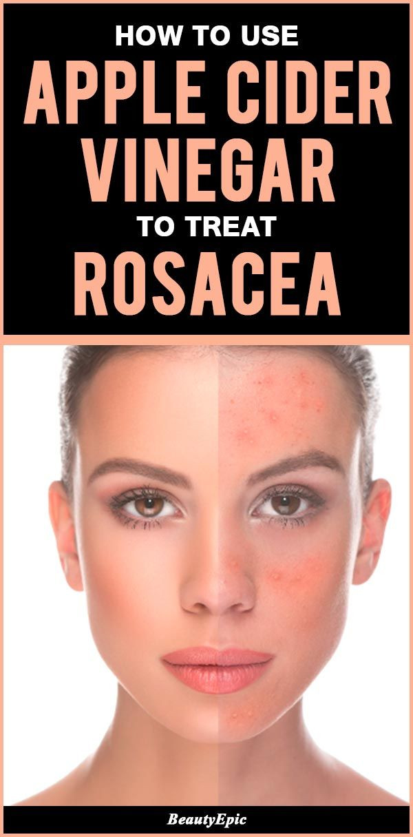 Best ideas about DIY Rosacea Treatment
. Save or Pin Best 25 Rosacea makeup ideas on Pinterest Now.