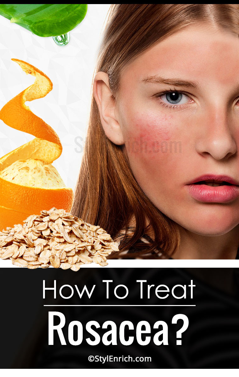 Best ideas about DIY Rosacea Treatment
. Save or Pin Wel e to Gabriel Atanbiyi Blog How to Treat Rosacea Now.