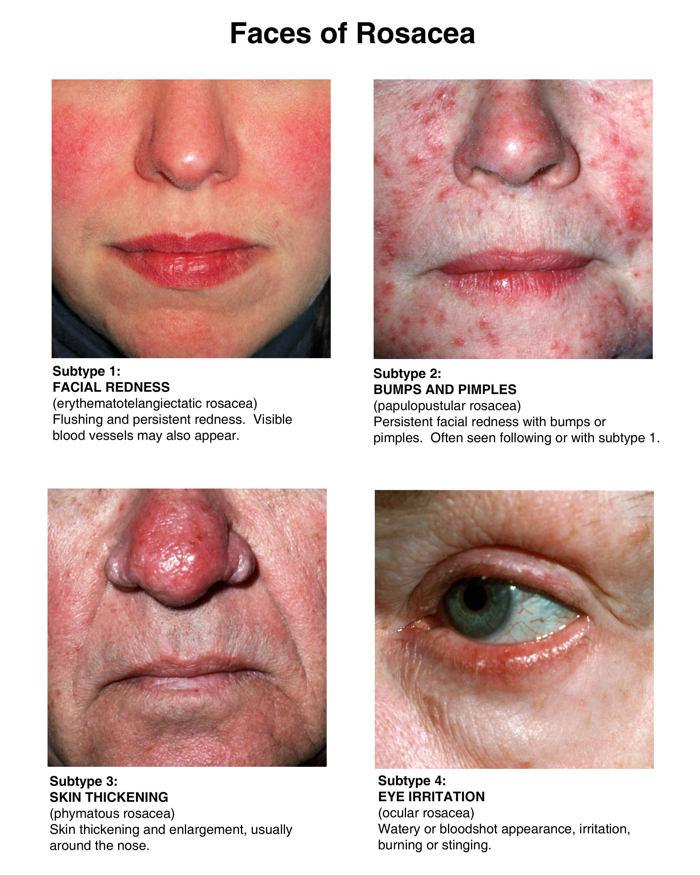 Best ideas about DIY Rosacea Treatment
. Save or Pin Possible herbal reme s Rosacea Now.