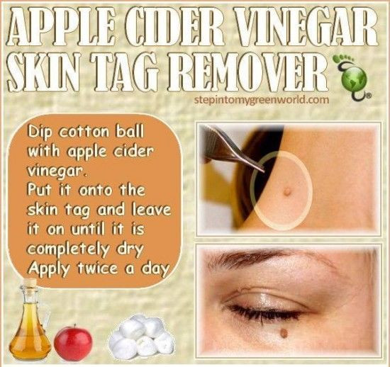 Best ideas about DIY Skin Tag Removal
. Save or Pin Apple Cider Vinegar Skin Tag Remover s and Now.