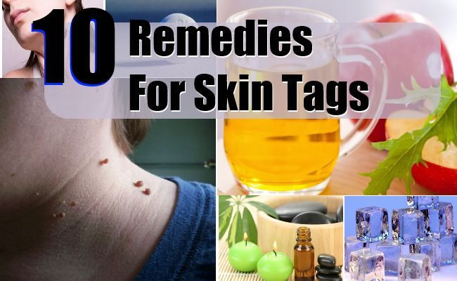 Best ideas about DIY Skin Tag Removal
. Save or Pin Reme s For Skin Tags DIY Pinterest Now.