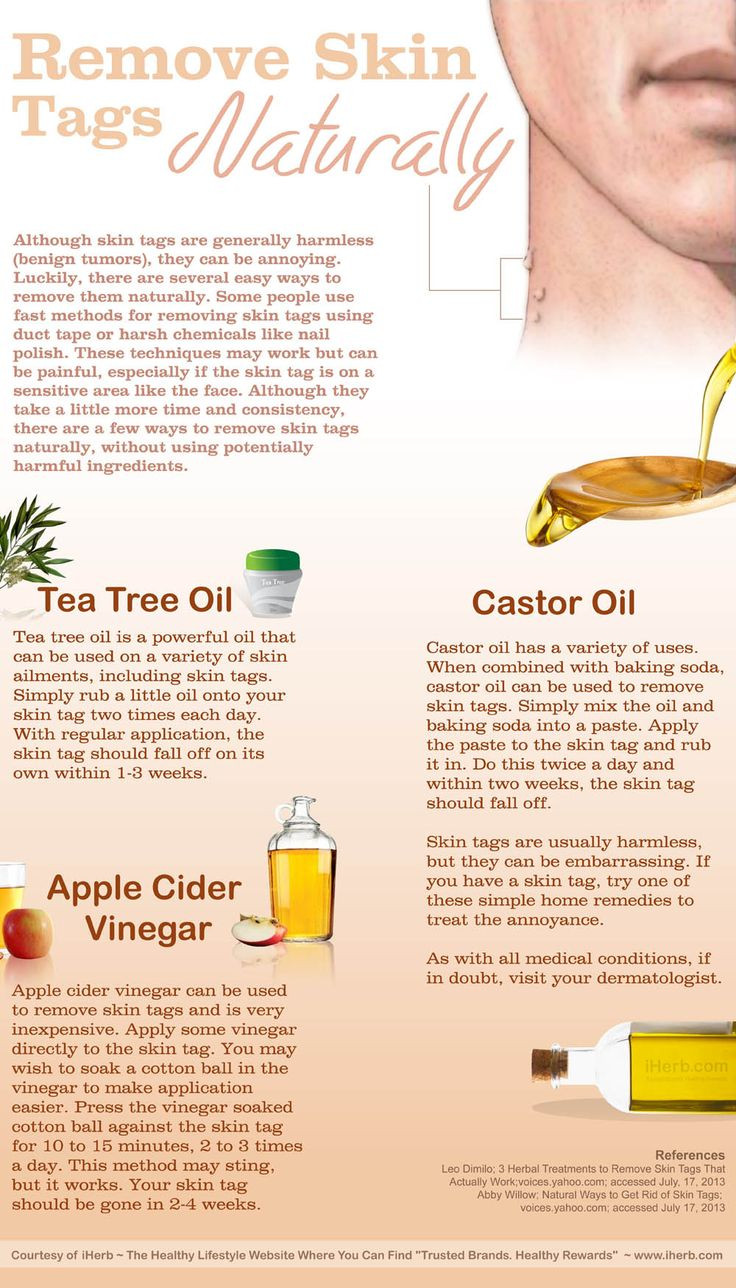 Best ideas about DIY Skin Tag Removal
. Save or Pin Ways to Remove Skin Tags Naturally with Tea Tree Oil Now.