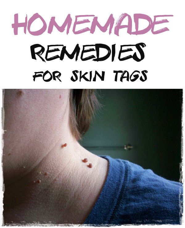 Best ideas about DIY Skin Tag Removal
. Save or Pin 12 Natural Reme s For Skin Tag Removal Home Reme s Now.