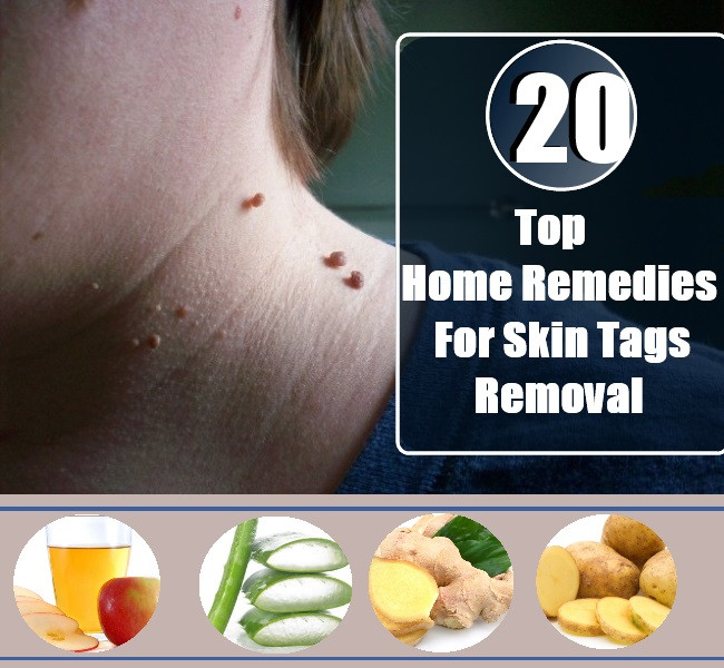 Best ideas about DIY Skin Tag Removal
. Save or Pin 20 Home Reme s For Skin Tags Removal Now.