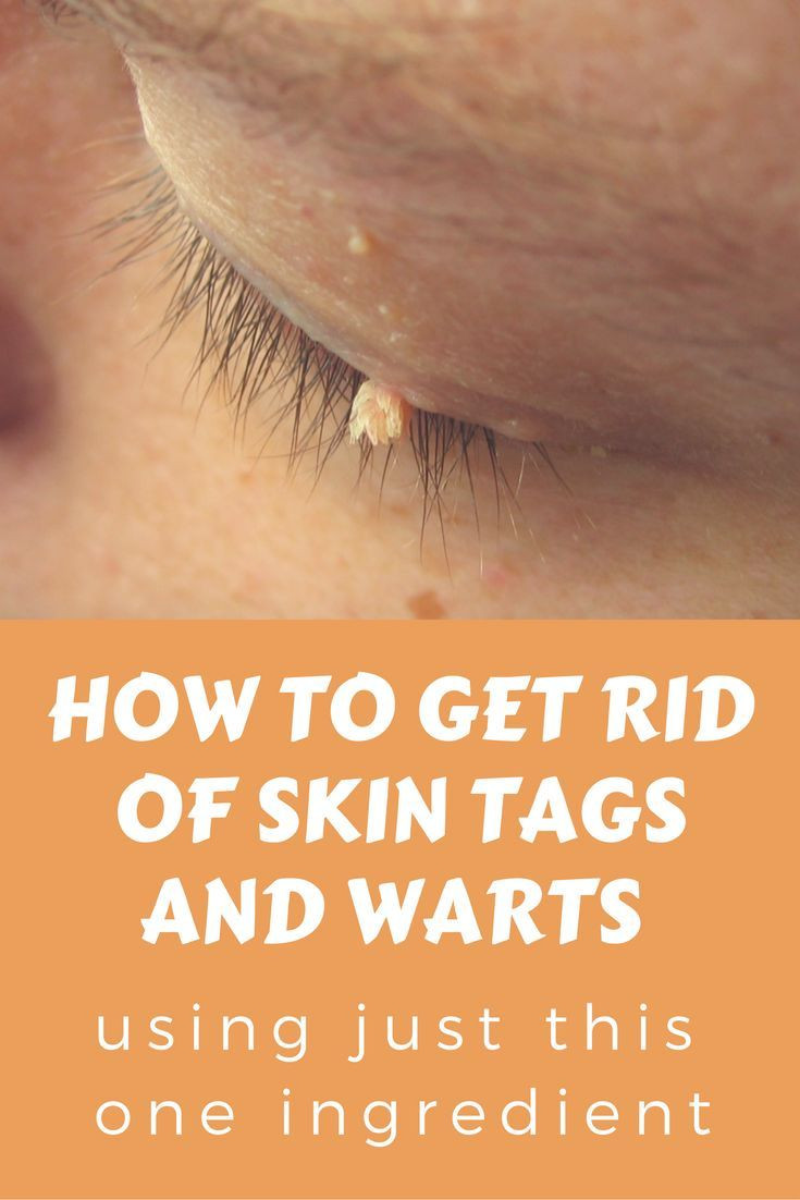 Best ideas about DIY Skin Tag Removal
. Save or Pin Best 25 Removal of skin tags ideas on Pinterest Now.