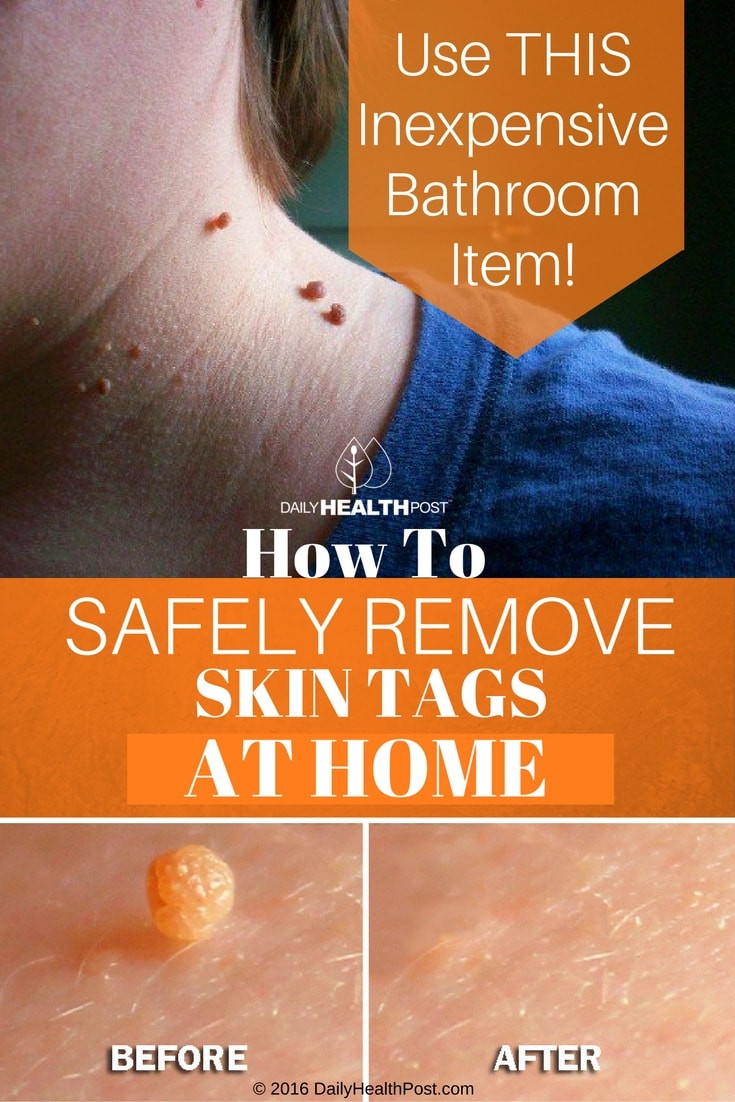 Best ideas about DIY Skin Tag Removal
. Save or Pin How To Safely Remove Skin Tags At Home Using THIS Now.