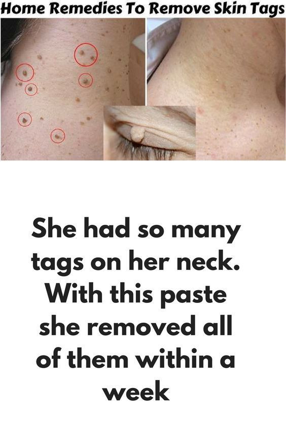Best ideas about DIY Skin Tag Removal
. Save or Pin 25 unique Removal of skin tags ideas on Pinterest Now.