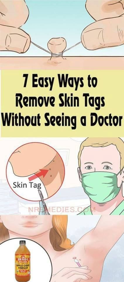 Best ideas about DIY Skin Tag Removal
. Save or Pin Beauty 8 Ways to naturally remove skin tags Now.