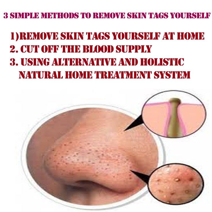 Best ideas about DIY Skin Tag Removal
. Save or Pin Pin by Laurie Craft on DIY Personal Products Now.