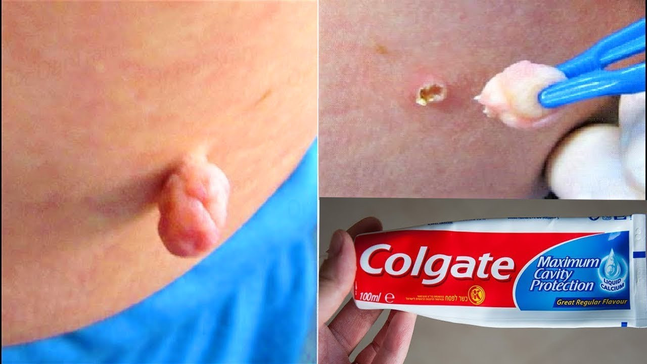 Best ideas about DIY Skin Tag Removal
. Save or Pin REMOVE SKIN TAG IN 1 NIGHT OF APPLYING TOOTHPASTE Now.