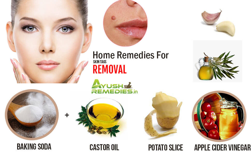 Best ideas about DIY Skin Tag Removal
. Save or Pin 6 Natural Home Reme s for Skin Tags Homemade Tips from Now.