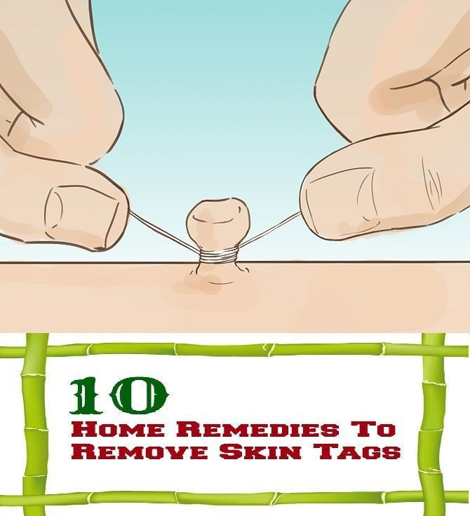 Best ideas about DIY Skin Tag Removal
. Save or Pin 17 Best images about h skin on Pinterest Now.