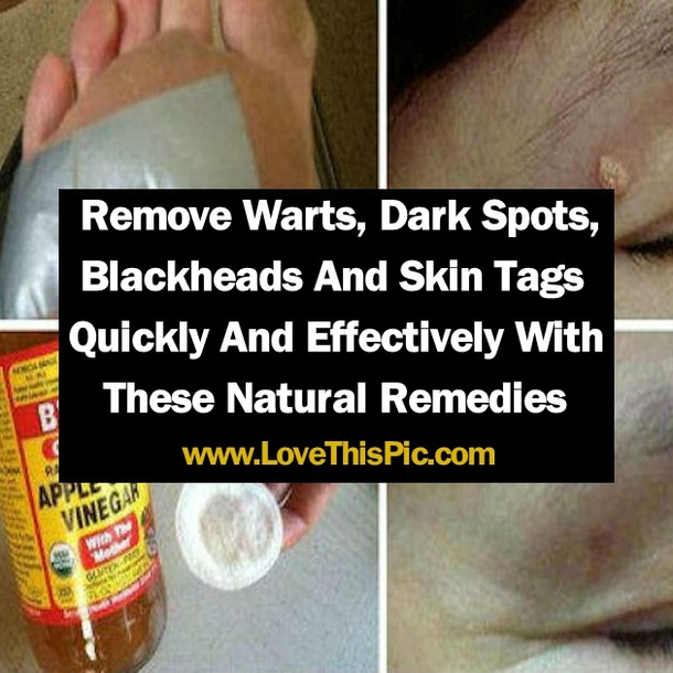 Best ideas about DIY Skin Tag Removal
. Save or Pin Remove Warts Blackheads Skin Tags And Dark Spots Now.